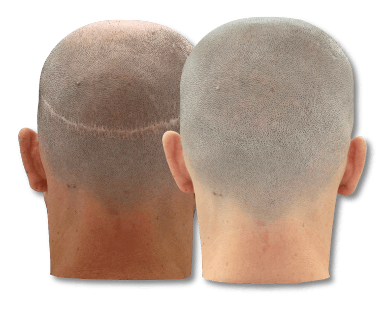 Before and after scalp micropigmentation results concealing a linear hair transplant scar.