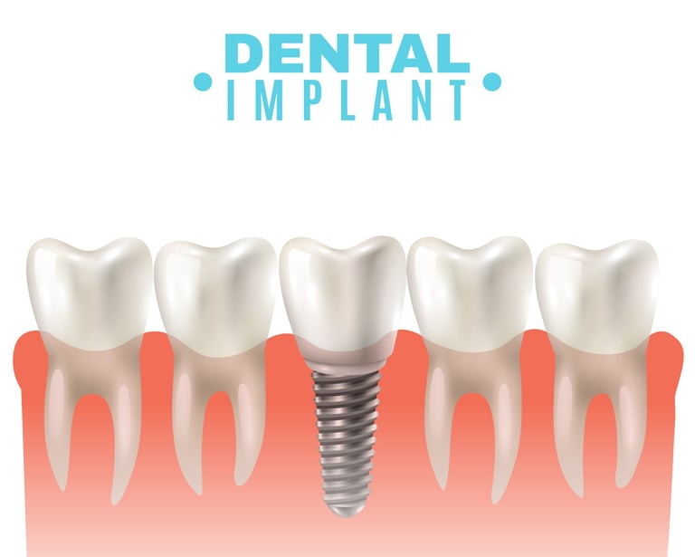 Best Dental Implants Clinic near me | Ekdantam Dental Clinic