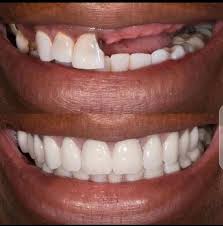 Restauration dentaire : dents manquantes remplacées par des facettes en porcelaine