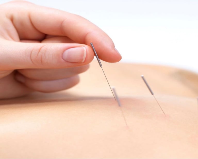 Acupuncture being performed on the back for pain relief