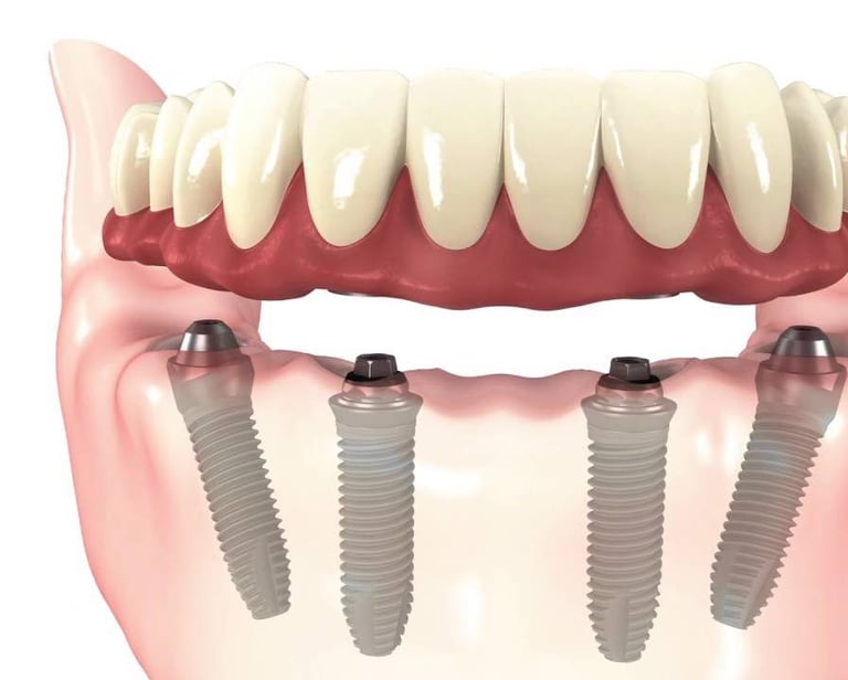 Get fix teeth with Dental Implants
