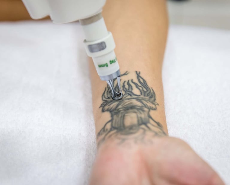 remocion laser de tatuajes