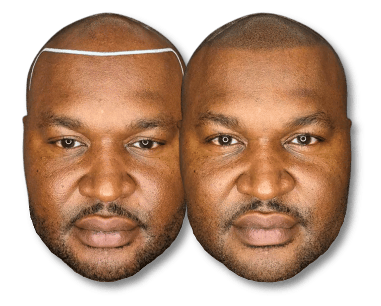 Before and after results of scalp micropigmentation for a natural-looking hairline on a bald man.