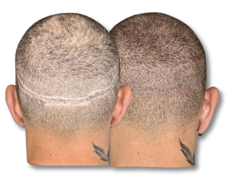Scalp micropigmentation before and after results concealing a linear hair transplant scar.