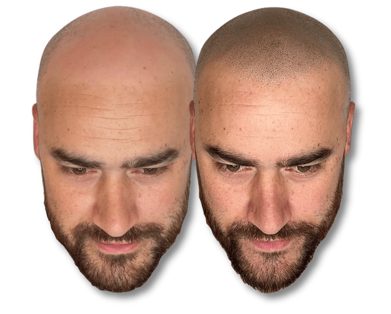Before and after scalp micropigmentation for a bald man showing natural hairline restoration results.