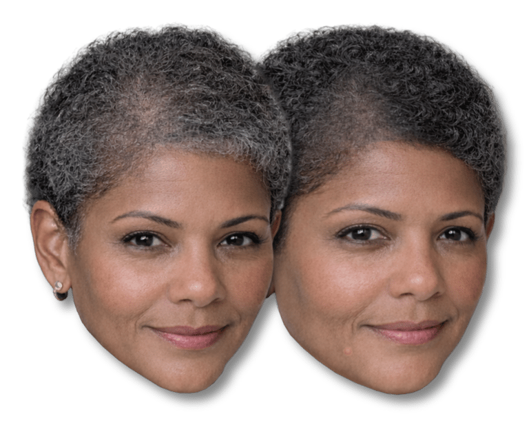 Before-and-after of a man's scalp micropigmentation, showing a fuller, denser hair look for hair loss solutions.