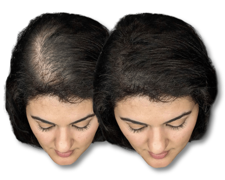 Before and after comparison of female hair thinning treatment showing increased scalp coverage.