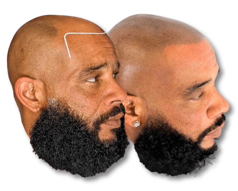 Before and after scalp micropigmentation results for a man with a beard to restore a natural hairline.
