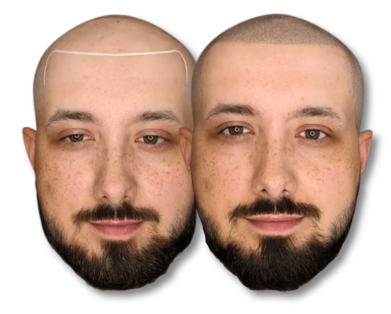 Before and after scalp micropigmentation results for a man with a bald head and beard.