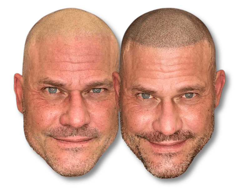 Before and after scalp micropigmentation results showing a realistic hair tattoo hairline on a bald man.