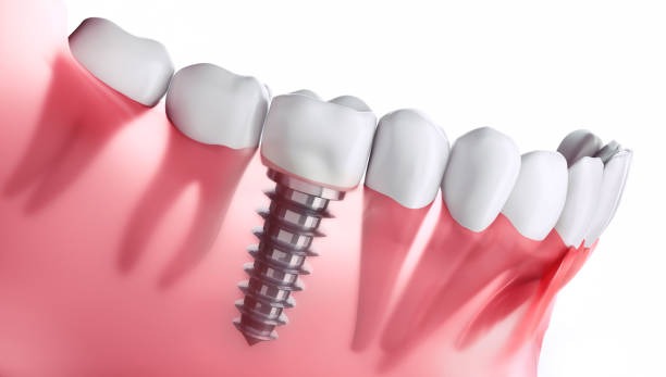 a single dental implant at  in white castle dental clinic katraj pune