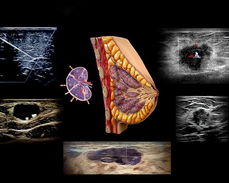 Medical diagram of breast anatomy shown with ultrasound scans for cancer screening and biopsy.