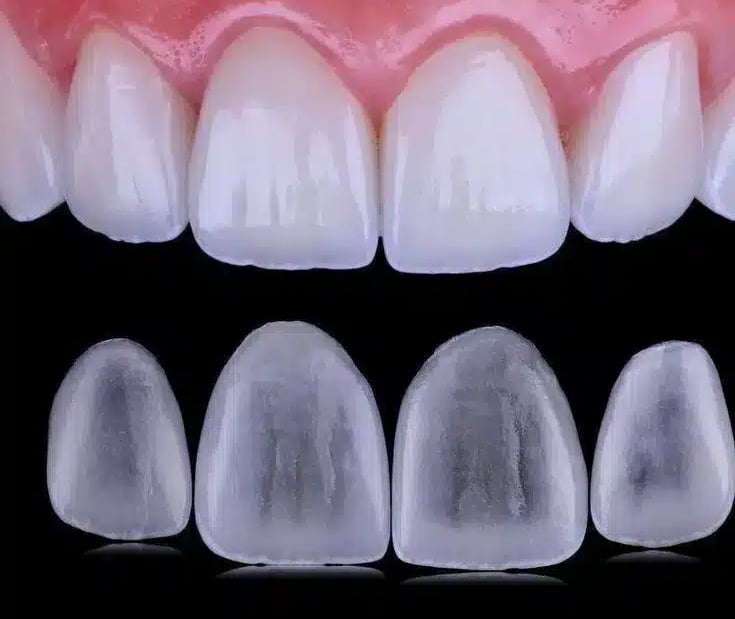 Sorriso bonito com facetas aplicadas por dentista na Lapa PR.