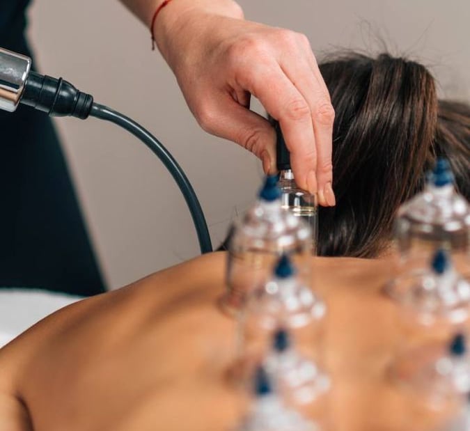 cupping therapy
