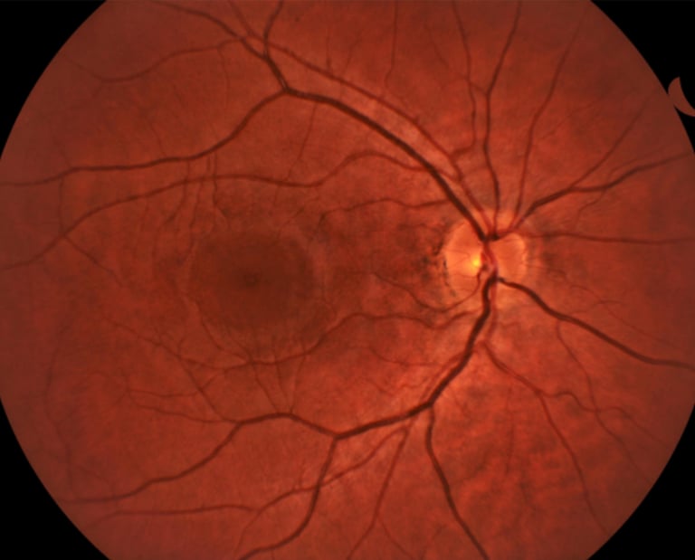 Retinal fundus photograph showing the optic nerve, macula, and blood vessels in a clinical eye exam.