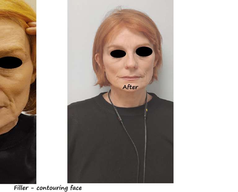 //   Before and after image filler facial contour – restored volume and more harmonious face.