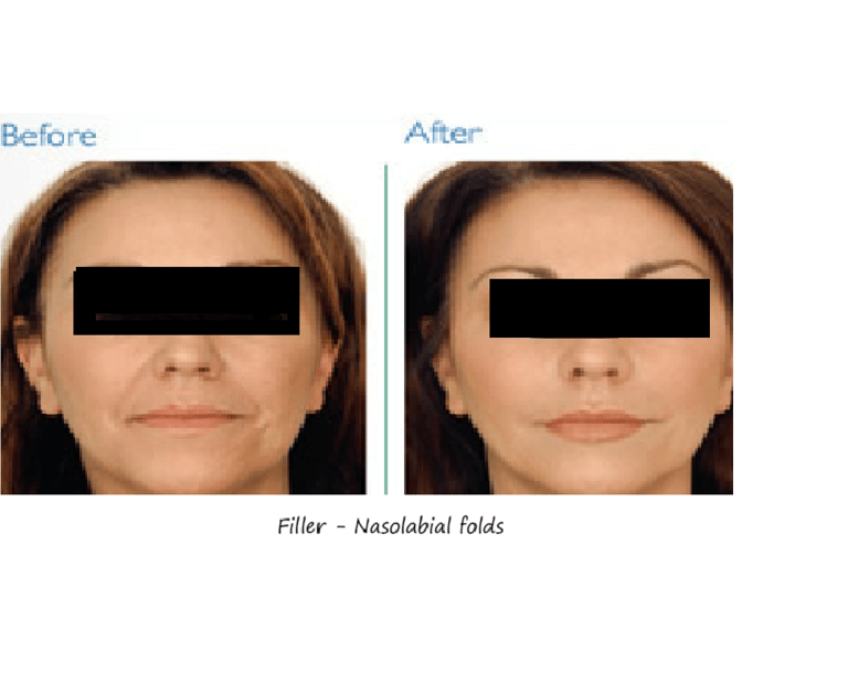 Filler nasolabial folds before and after – smoother skin and younger appearance after correction.