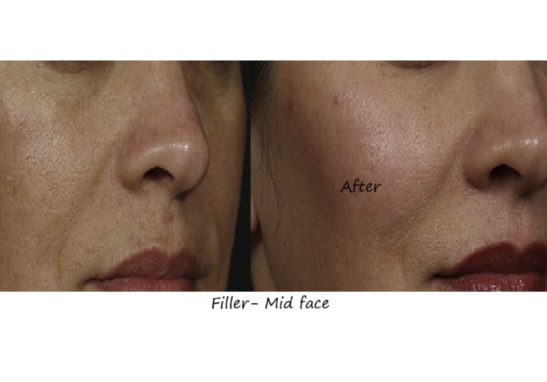 Before & after image fillers cheeks – restored volume, improved contour and natural fullness.