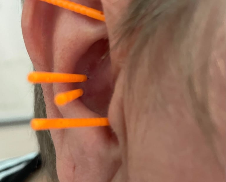 ear acupuncture