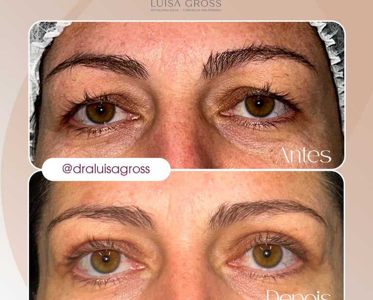 Antes e depois de cirurgia periocular realizada pela Dra. Luisa Gross
