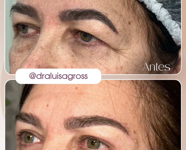 Antes e depois de cirurgia periocular realizada pela Dra. Luisa Gross