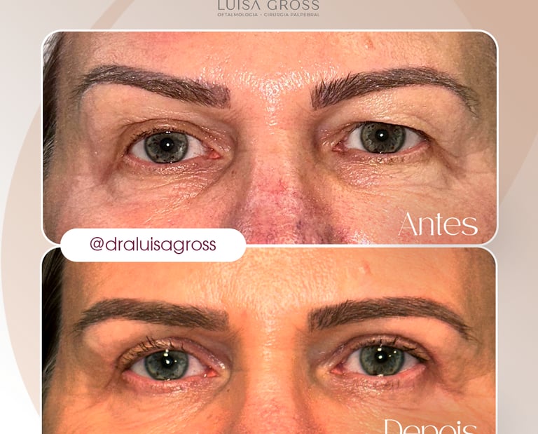 Antes e depois de cirurgia periocular realizada pela Dra. Luisa Gross