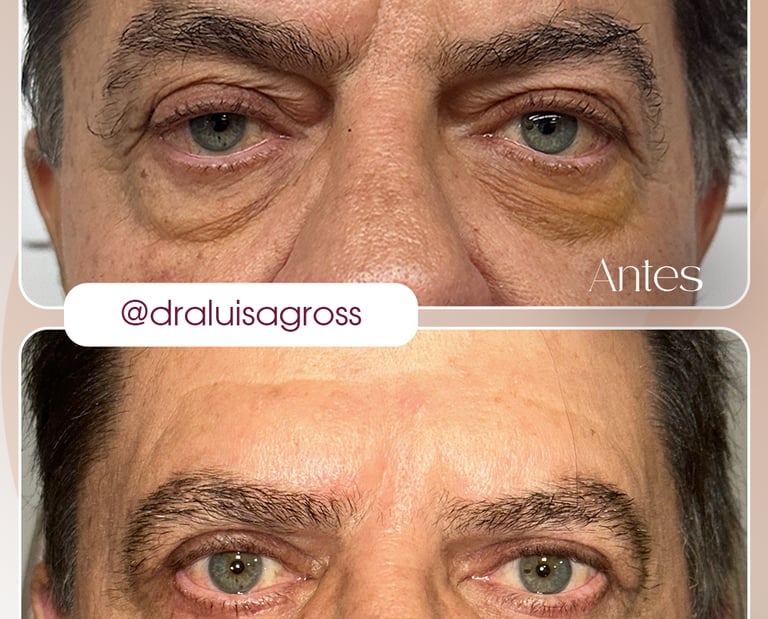Antes e depois de cirurgia periocular realizada pela Dra. Luisa Gross