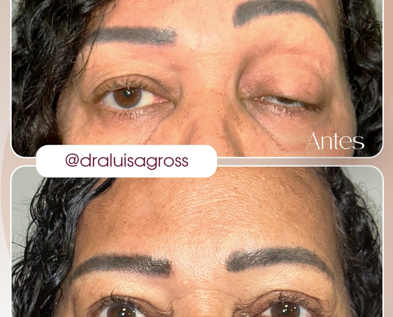 Antes e depois de cirurgia periocular realizada pela Dra. Luisa Gross