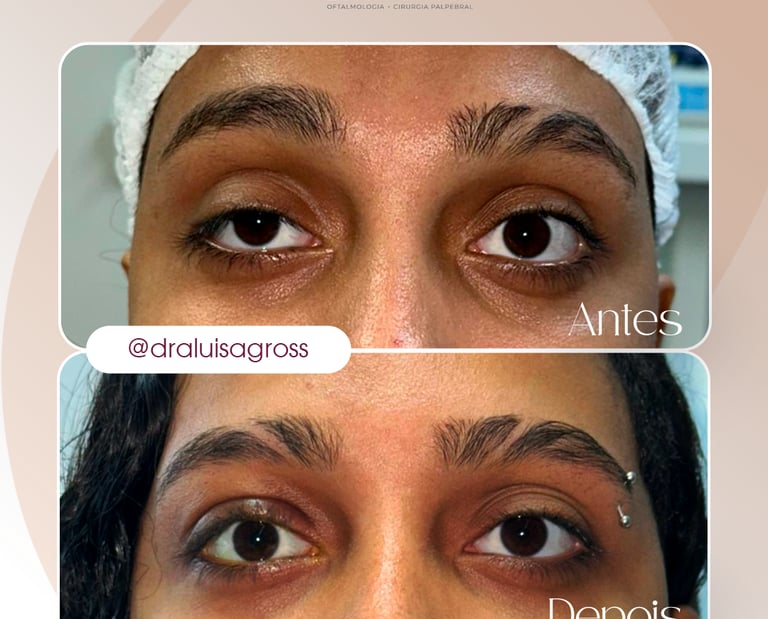 Antes e depois de cirurgia periocular realizada pela Dra. Luisa Gross