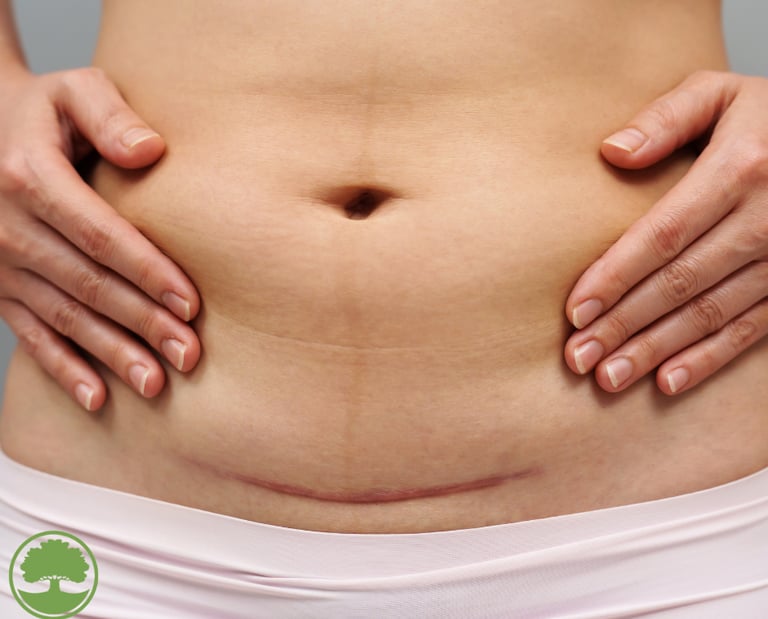 c section scar on woman for scar tissue therapy