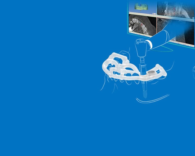 A dental surgical guide kit with digital software for guided implant surgery planning.