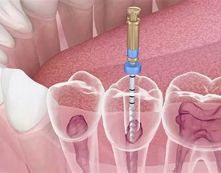 Trattamento-endodontico-devitalizzazione