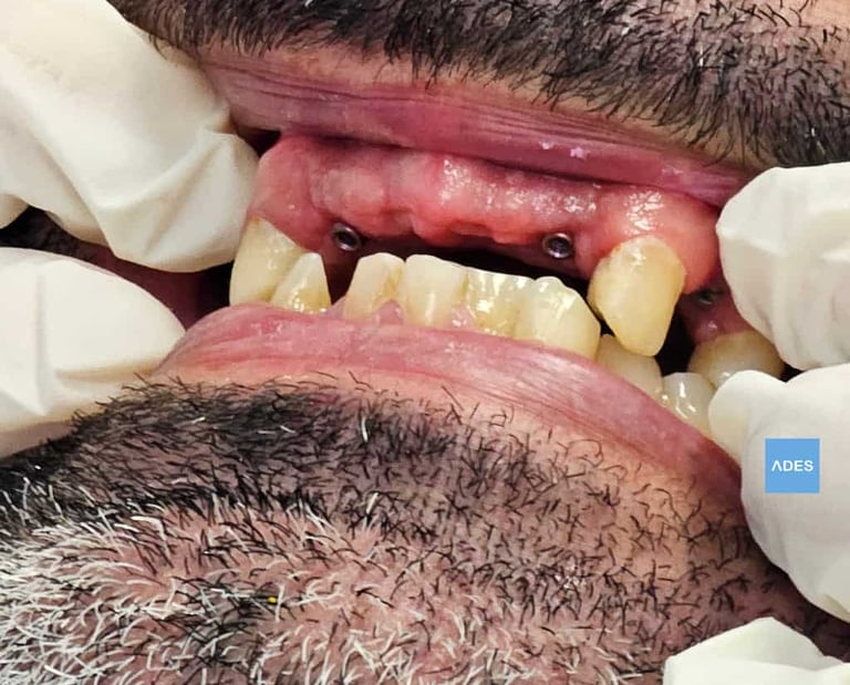 colocación implantes