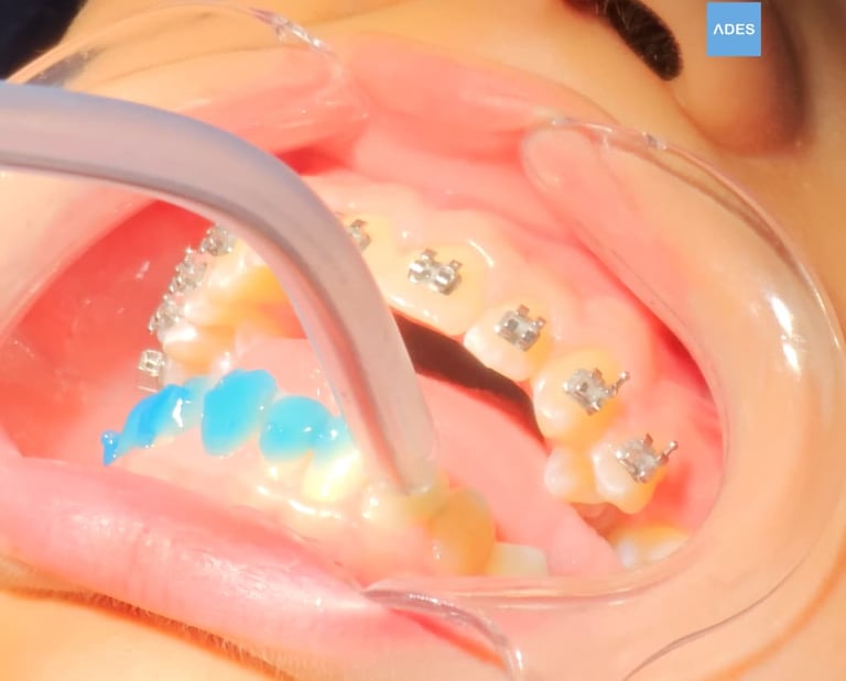 cementado brackets clinica dental ades