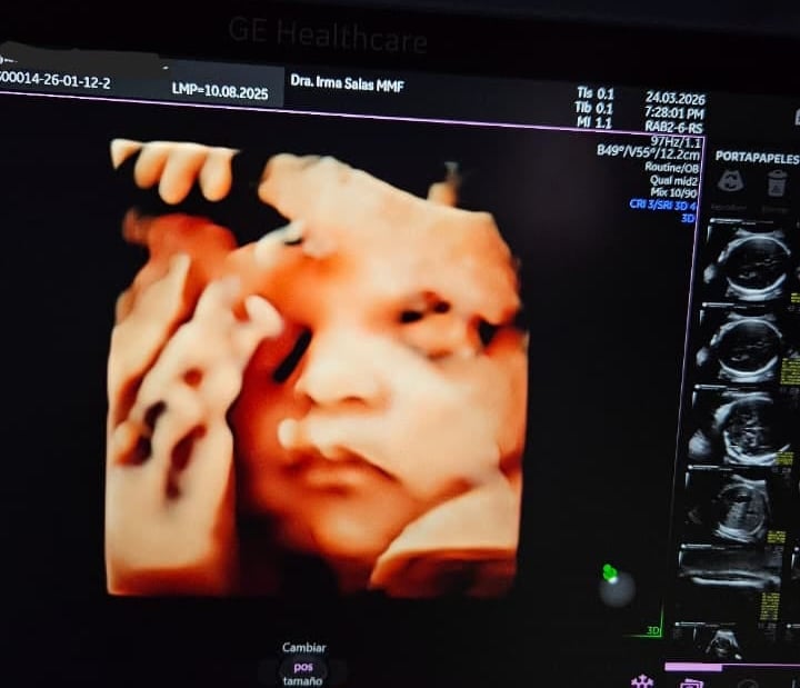 Ultrasonido estructural, ultrasonido segundo trimestre, ultrasonido 3D
