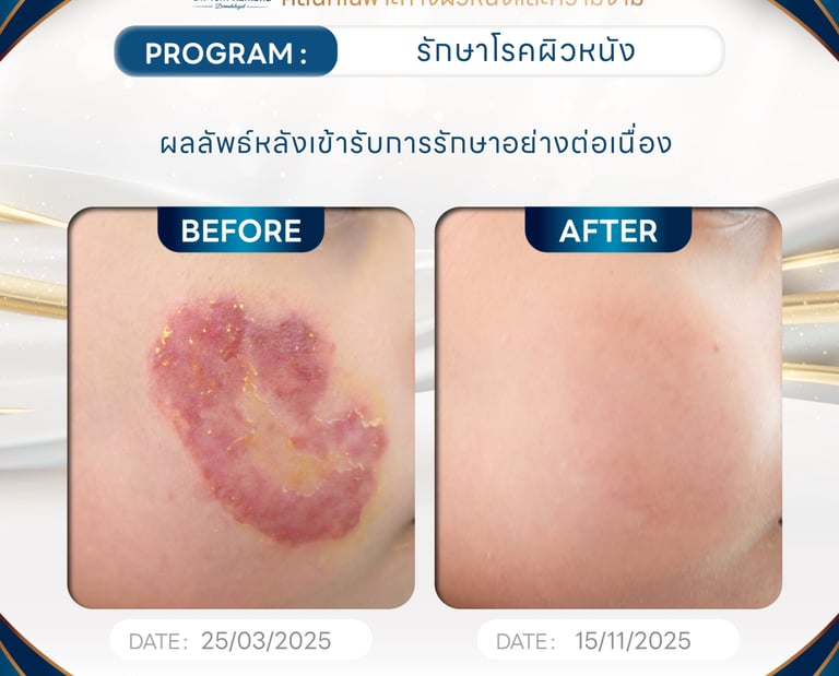 กลากบริเวณใบหน้า