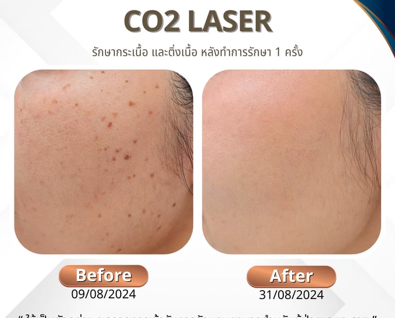 Seborrehic keratosis กระเนื้อ ติ่งเนื้อ