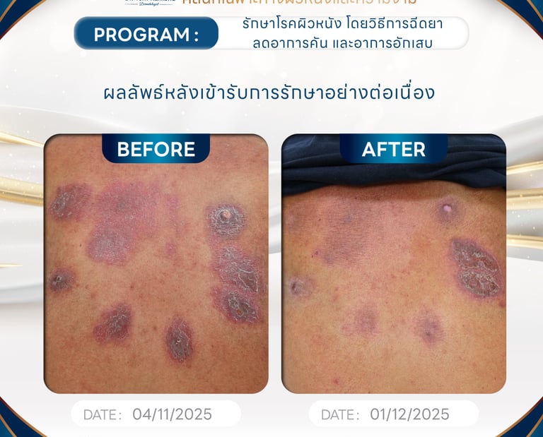 ผื่นแพ้เรื้อรัง