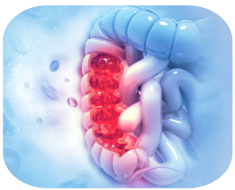 illustration des MICI-Prise en charge nutritionnelle
