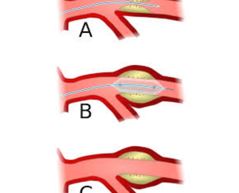 angioplasty