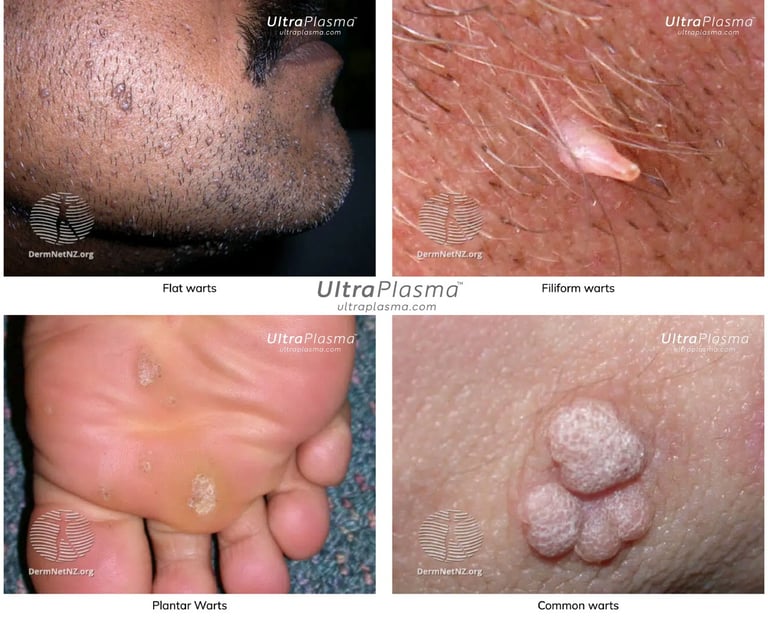 ultraplasma.com_wart_treatment_sigil_tedavisi_ultra_plasma_ultra_plazma_wart_plantar_flat_common