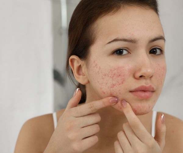 a woman with acnepticted skin and acneptic on her face