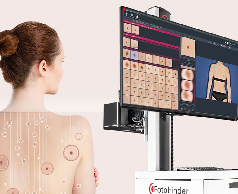 urmarire alunite videodermatoscopie fotofinder