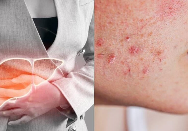 Señales de Hígado Graso en la Piel: Lo que tu Cuerpo te Está Diciendo
