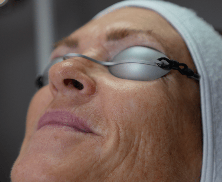 Ansigt, forud for behandling med FRAX Laser.