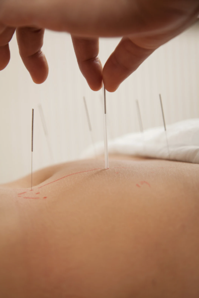 Dr. Xiong inserting acupuncture needles into a patient's abdomen for fertility support.