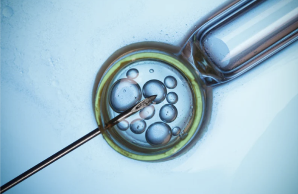 A close-up view of an intracytoplasmic sperm injection procedure under a microscope in a fertility clinic lab.