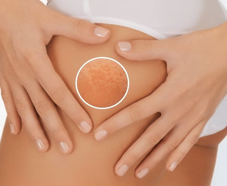 mesoterapia per cellulite e pelle a buccia d'arancia