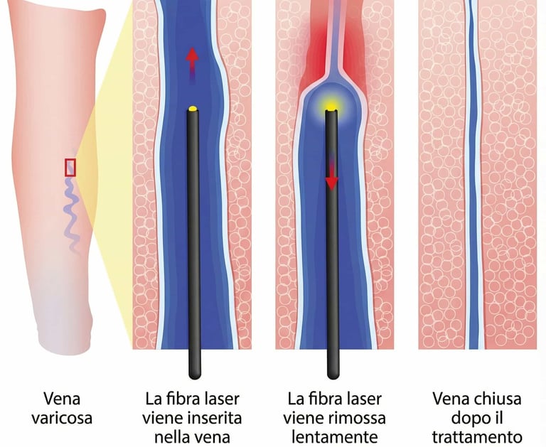 laser safena varici
