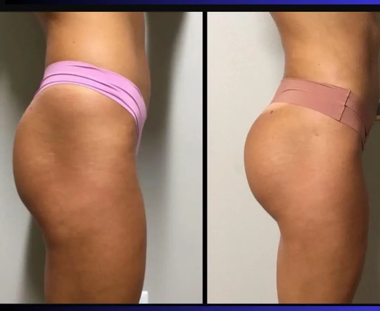 BBL before after photos in Antalya, Türkiye